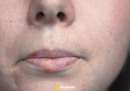 Niedoczynność tarczycy widać po twarzy. Oto jak wygląda 