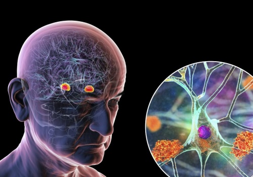 Znaleźli czynnik sprzyjający chorobie Alzheimera. Jest wokół nas