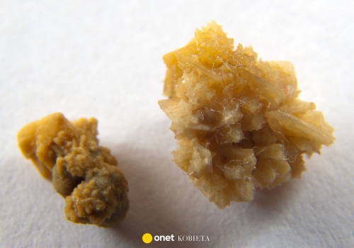 Myśleli, że ukradli złoto. Okazało się, że to kamienie nerkowe. Niecodzienna sytuacja we Włoszech 