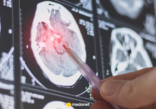 Nowy sposób walki z chorobą Alzheimera. Pacjent będzie leczony w trakcie snu