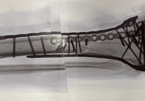 Lindsey Vonn przeszła koszmar. Odkryła szokującą rzeczywistość po wypadku