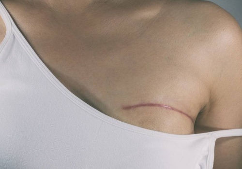 Zmagała się z gigantomastią. Zmniejszyła piersi z rozmiaru N do C