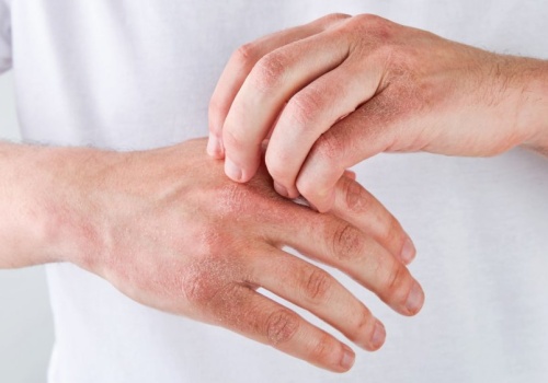 Sposoby na suche ręce zimą. Wybrałam dla was te, które testowałam i działają