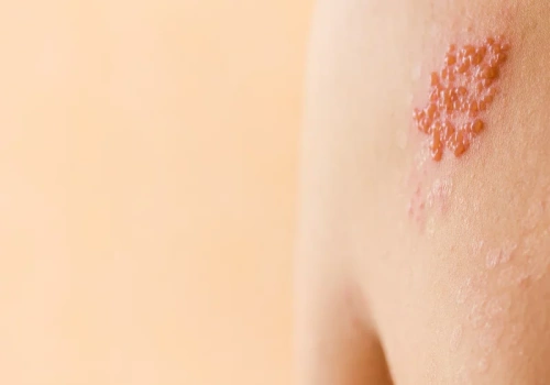 Prof. Paradowska-Stankiewicz: Przeciwko półpaścowi można się szczepić przez cały rok