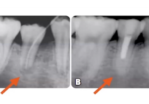 Niebezpieczeństwa związane z leczeniem kanałowym i sposoby ich leczenia