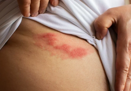 Fakty i mity na temat półpaśca. O tym trzeba wiedzieć