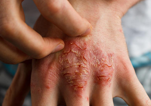 Dziesięć prostych i naturalnych sposobów leczenia egzemy