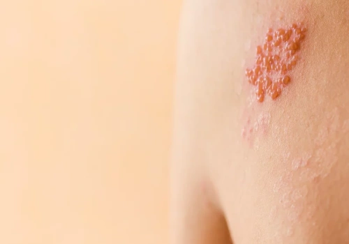 Półpasiec grozi milionom Polaków. Eksperci mówią jasno, kto powinien się zaszczepić