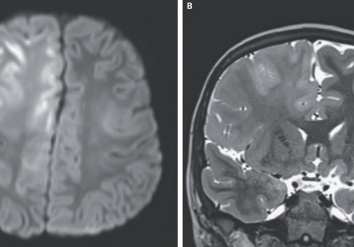 Tak wygląda mózg zniszczony przez odrę. A wystarczyło szczepienie