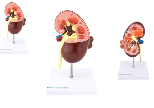 Kłębuszkowe zapalenie nerek – przyczyny, objawy i leczenie