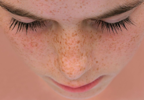 Jak powstają piegi? Najlepsze sposoby na usuwanie piegów na twarzy i zapobieganie ich powstawaniu