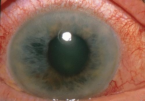 Jaskra kradnie wzrok 800 tysiącom Polaków. Rusza X edycja bezpłatnych badań okulistycznych