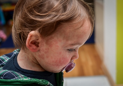 Odra w UK: Nieszczepione dzieci mogą zostać odesłane ze szkoły do domu