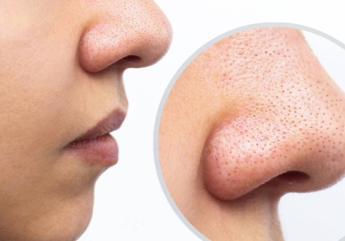 Ten peeling wyciąga zaskórniki jak odkurzacz! Pozbądź się w końcu czarnych kropek z nosa