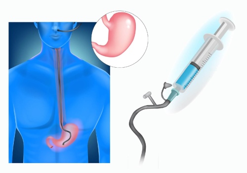 Sondy (zgłębniki) żołądkowe