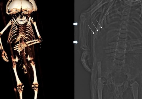 Bez słońca, zabawy, ruchu. Na zamkach i dworach hodowano kalekie dzieci