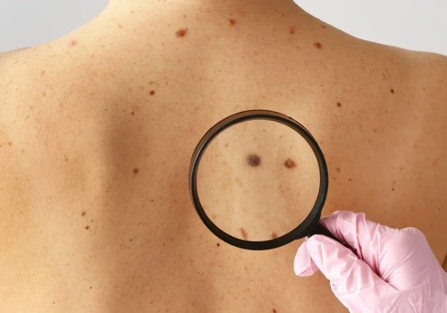 Onkolodzy alarmują: Coraz więcej zachorowań na czerniaka. Połowa przypadków wykrywana zbyt późno