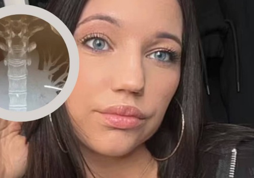 Chciała usunąć implant antykoncepcyjny. Lekarze ze strachem odkryli, gdzie się przemieścił