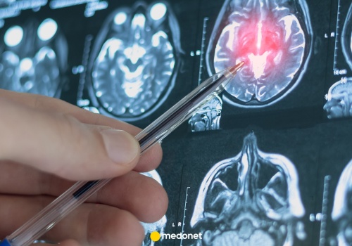 Pierwsza taka operacja glejaka w Polsce. Lekarze z Łodzi dokonali przełomu