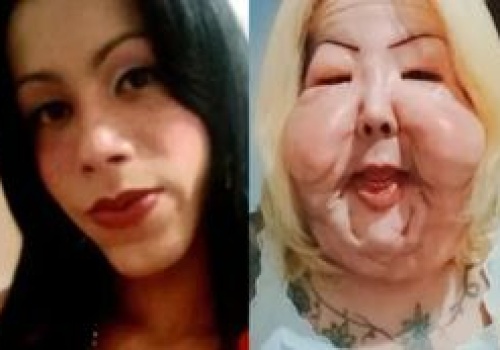 Chciała poprawić urodę. Dziś walczy o odzyskanie dawnej twarzy