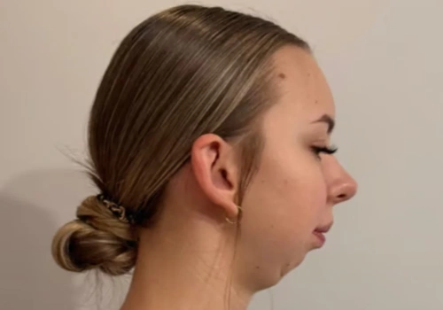 Milena Borchardt zbiera na operację szczęki. „To moja jedyna szansa”