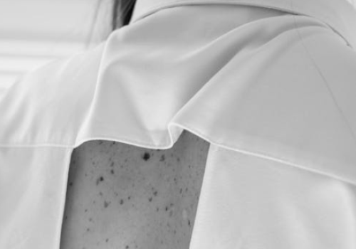 Łupież pstry - czy jest zaraźliwy?