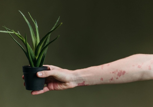 Łupież różowy – charakterystyczna wysypka o nieznanej przyczynie