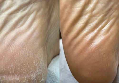 To najlepsza mikstura na popękane pięty. Rozwiąże problem w jedną noc