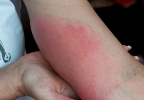 Coraz więcej zakażonych. To już nie jest problem sezonowy