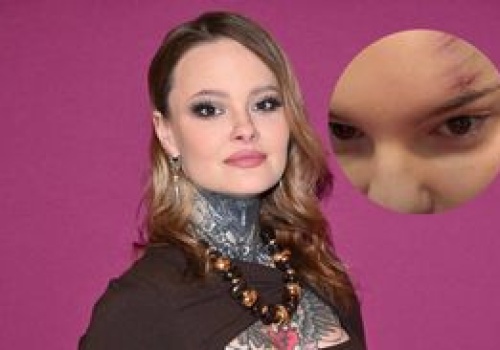 Monika Miller pokazała swoje RANY w sieci. 