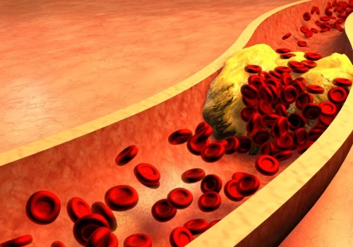 Kardiolog o mitach z wiązanych z miażdżycą, cholesterolem i statynami. „Słyszałem, że zmuszam do trucizny