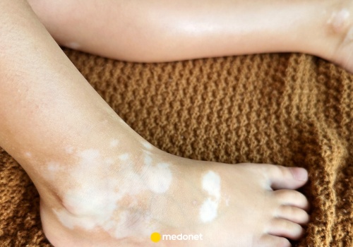 W czym jest melanina? Tak wspomożesz produkcję melaniny w ciele