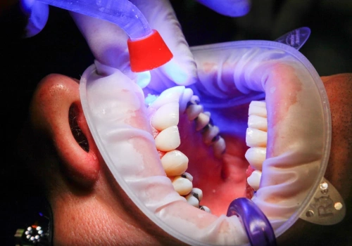 Chciał odliczyć równe zęby od podatku. Cios fiskusa w szczękę