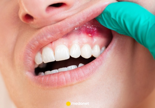 Masz krwawiące dziąsła? Uważaj, to mogą być problemy z sercem