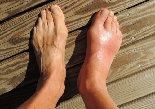 Ukryte czynniki wywołujące dnę moczanową: W jaki sposób dieta i styl życia nasilają ból – i jak temu zapobiegać