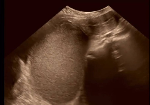 14-latka nigdy nie miała okresu. Wynik USG zszokował lekarzy