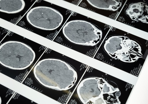 Jak rozwija się choroba Alzheimera? Naukowcy odkryli drogę rozprzestrzeniania się białka tau