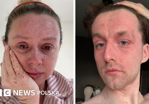 'Nasza skóra odpada i nikt nie potrafi nam powiedzieć, dlaczego'