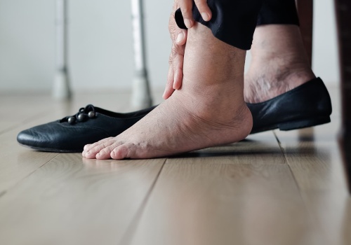 Obrzęk kostek – przyczyny, diagnostyka i leczenie