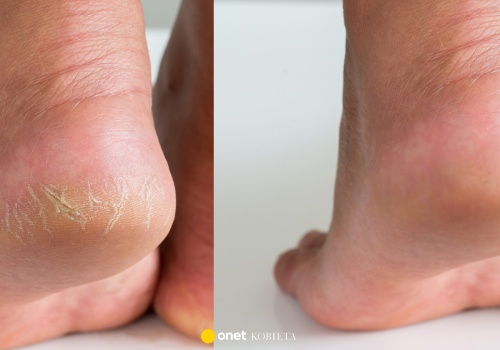 Szorstkie pięty? Ten naturalny peeling z olejkami robi z nimi porządek w kilka minut