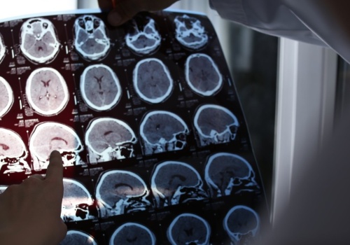 Po 40-tce zadbaj o prawidłowy poziom witaminy D. Zmniejsza ryzyko alzheimera