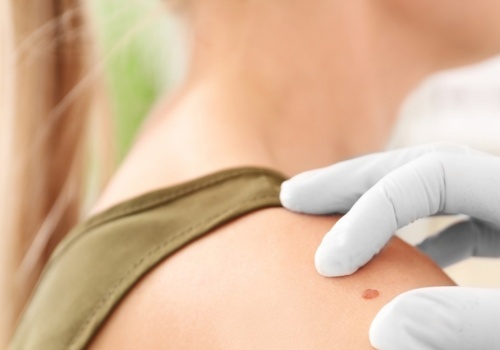 AI zmienia diagnostykę raka skóry. Czerniak pod kontrolą algorytmów