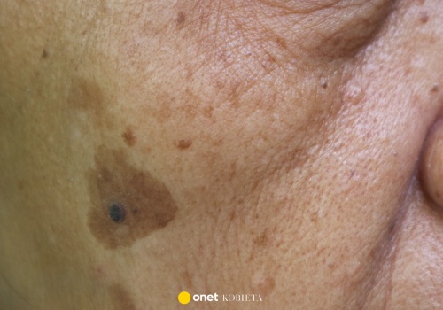 Ten krem na noc to likwidator plamek starczych! Usuwa przebarwienia w mig