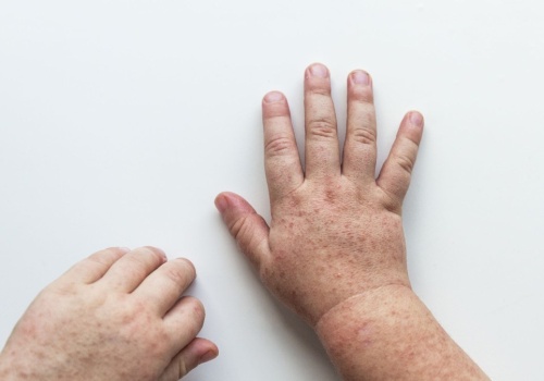 Genom sprzed wieków ujawnia tajemnicę szkarlatyny. Zaskakujące odkrycie