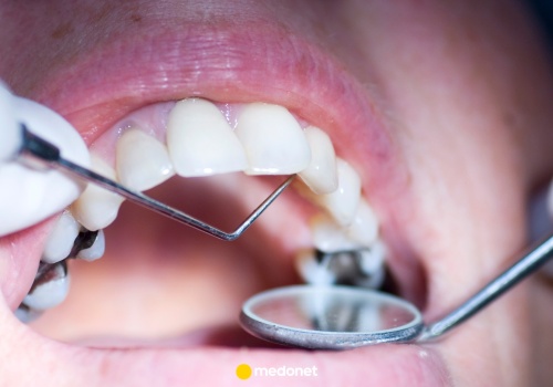 Tragiczny finał wizyty u dentysty. Lekarz oskarżony o śmierć pacjenta usłyszy wyrok