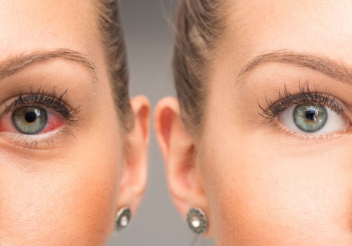 Nużeniec – czym jest, jakie daje objawy, jak go leczyć?