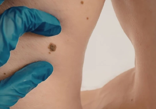 Czerniak długo nie daje objawów, dlatego łatwo go przegapić