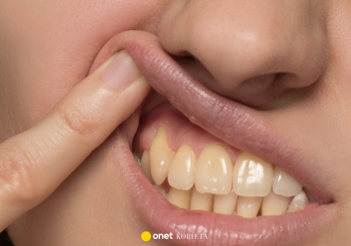 Od czego robią się żółte zęby? Higienistka stomatologiczna wyjaśnia