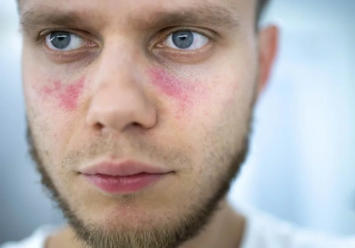 Pierwsza od 70 lat realna szansa na skuteczne leczenie skórnej postaci tocznia rumieniowatego