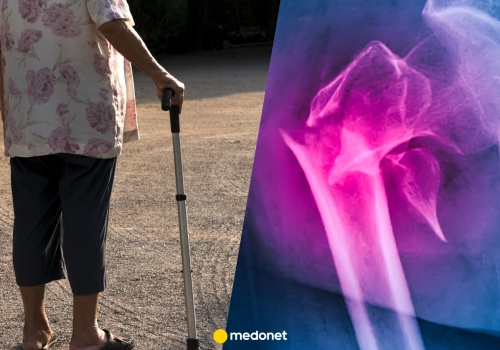 Cicha epidemia osteopenii. Oto dlaczego twoje kości są coraz słabsze